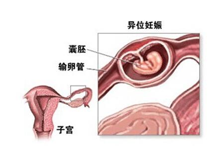 怎么预防宫外孕