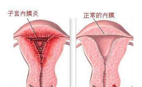 子宫内膜炎的危害