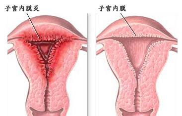 宫内膜炎的具体危害
